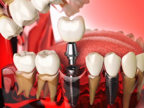 Implant dentaire en titane